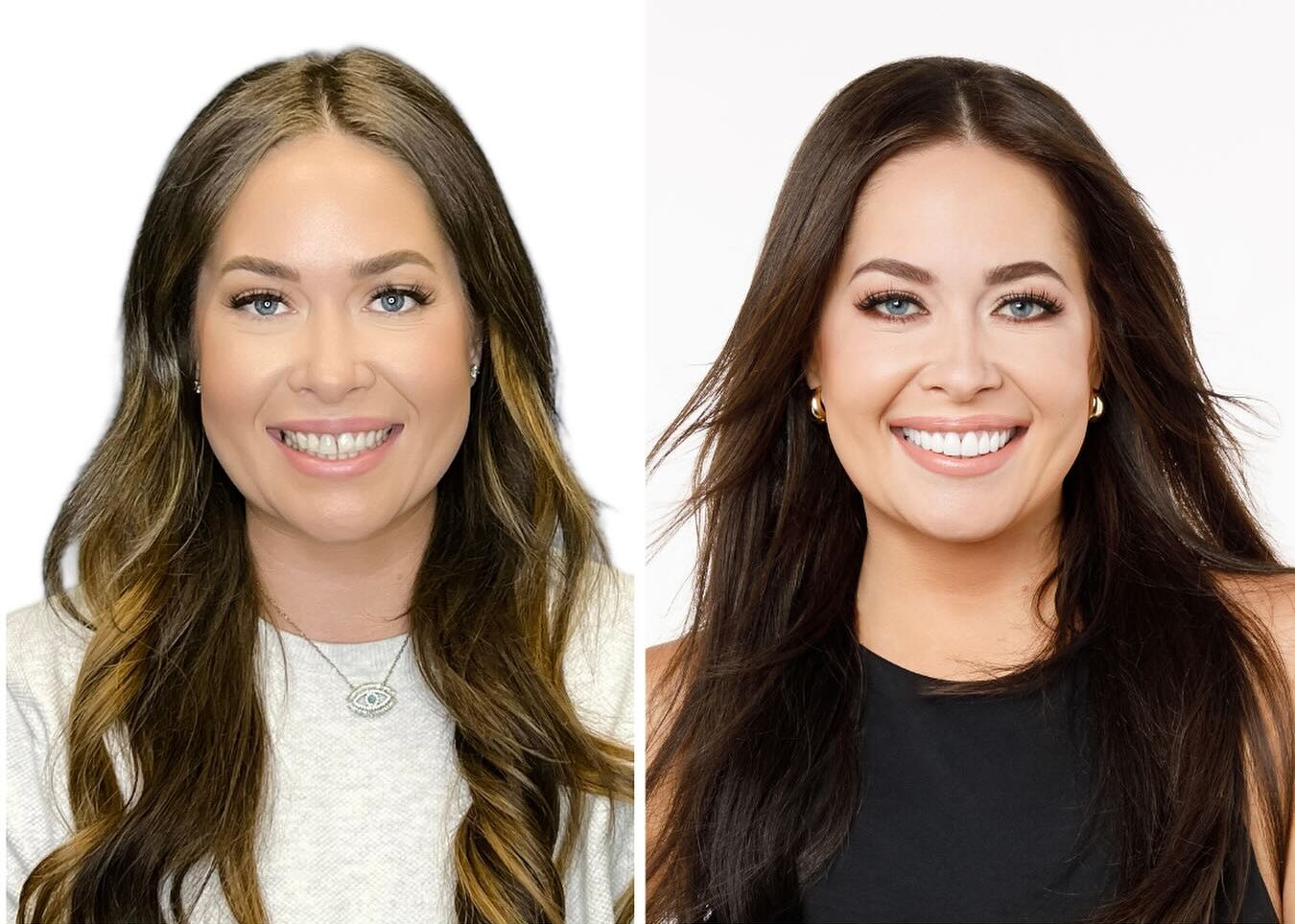 Before and after veneers