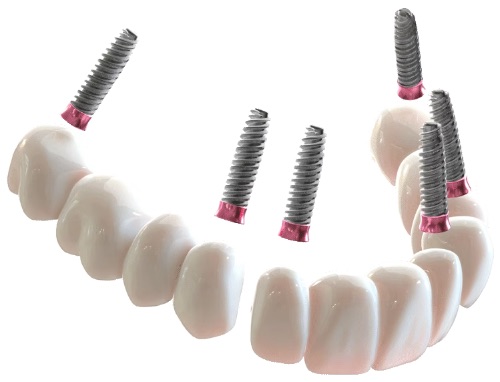 3 on 6 segmented implant bridge