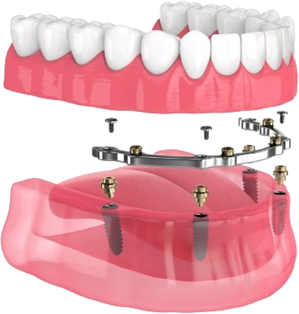 Bar implant attachment model