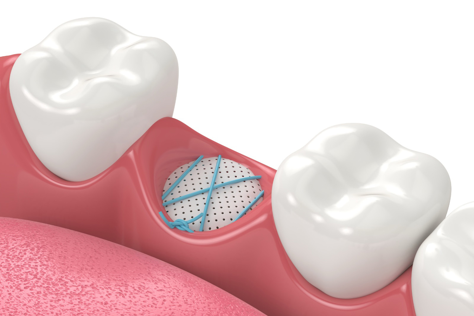 Bone grafting 3D model