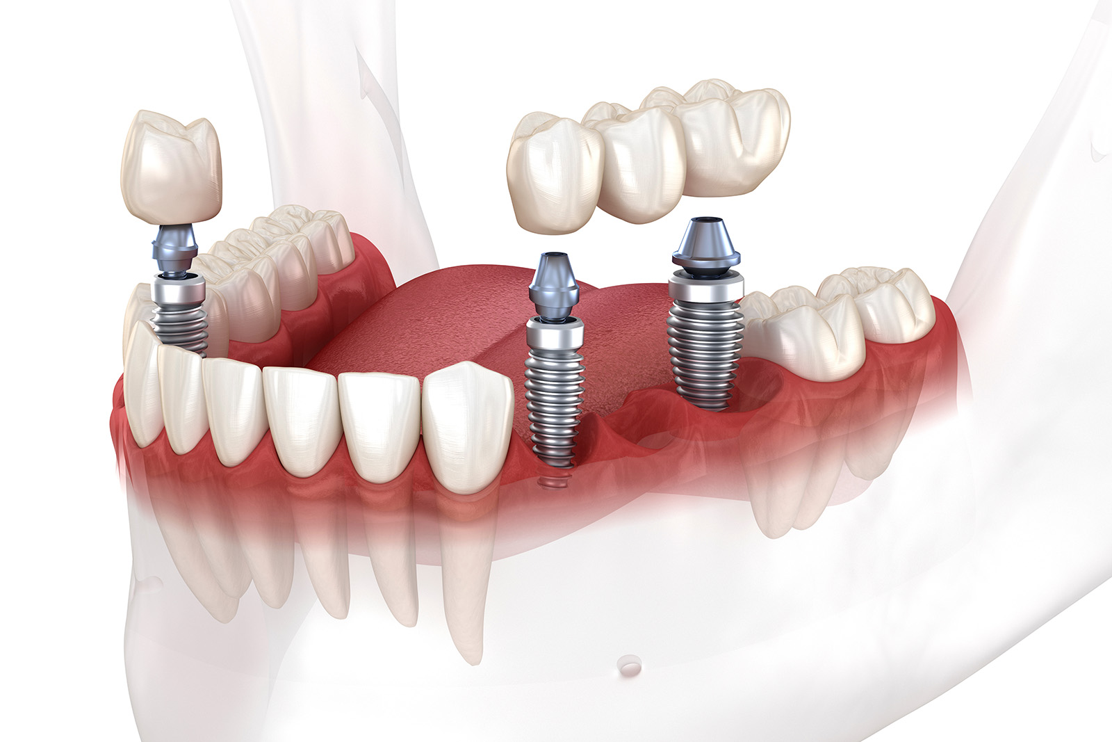 Dental implants