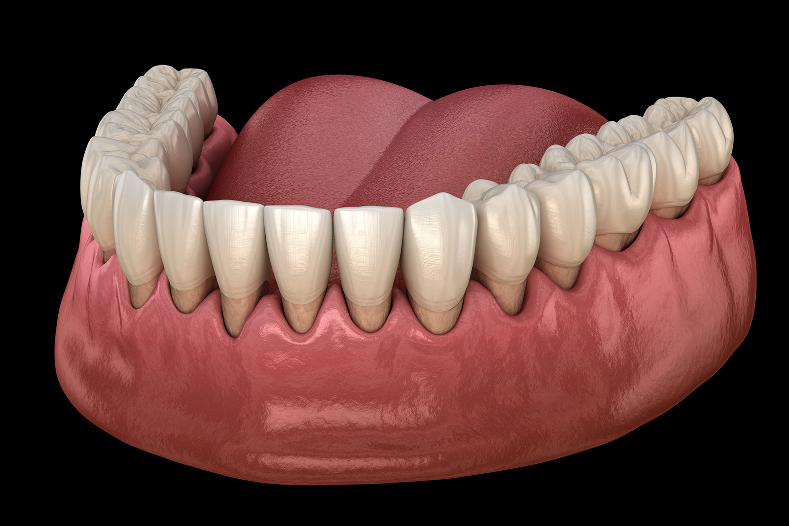 Gum recession model