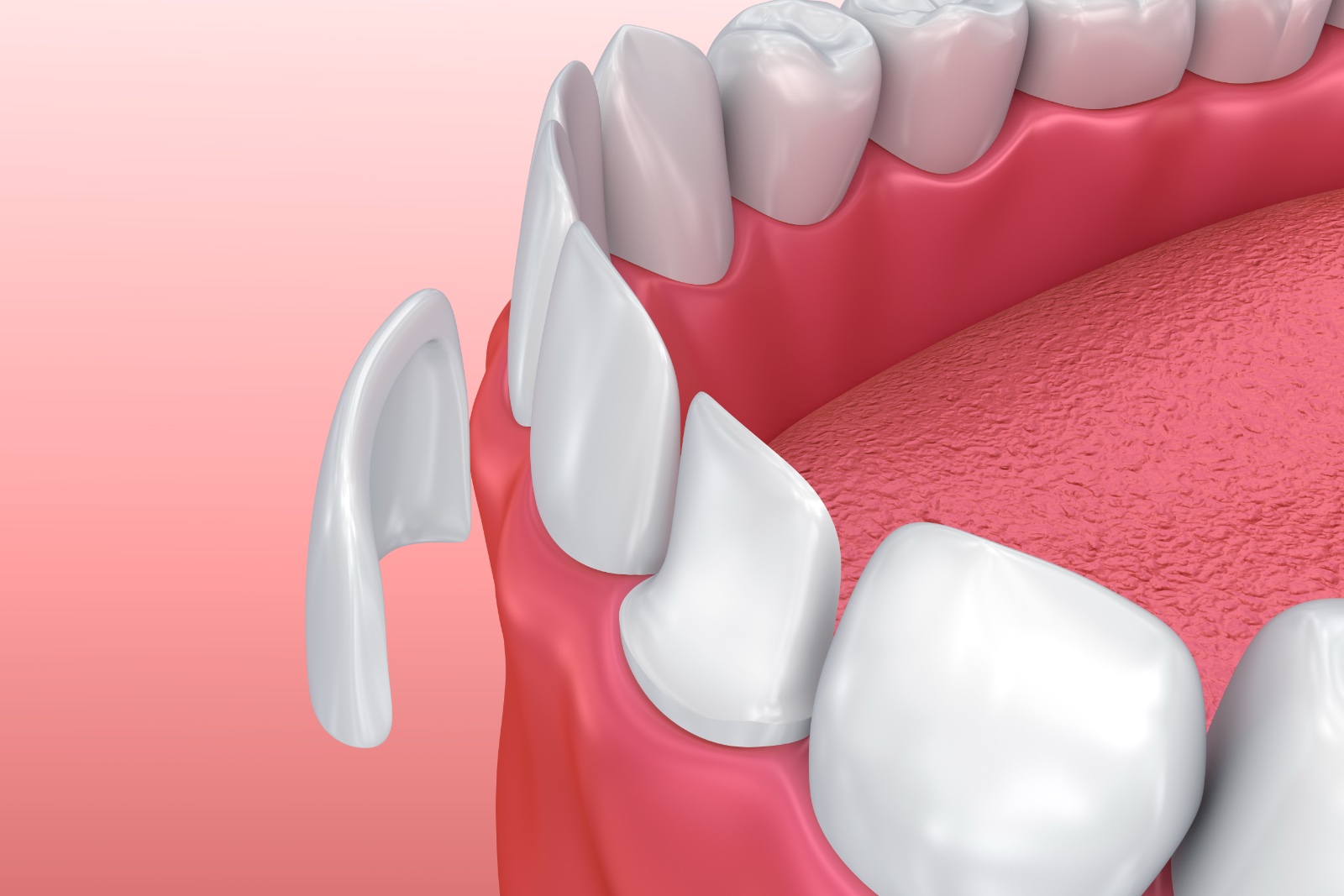 Dental Veneers: Porcelain Veneer installation Procedure. 3D illustration